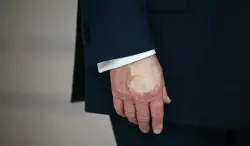 جدل واسع بعد ظهور كدمة على يد ترامب مغطاة بطبقة مكياج